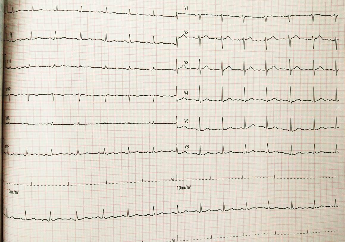 左主干病变心电图图片