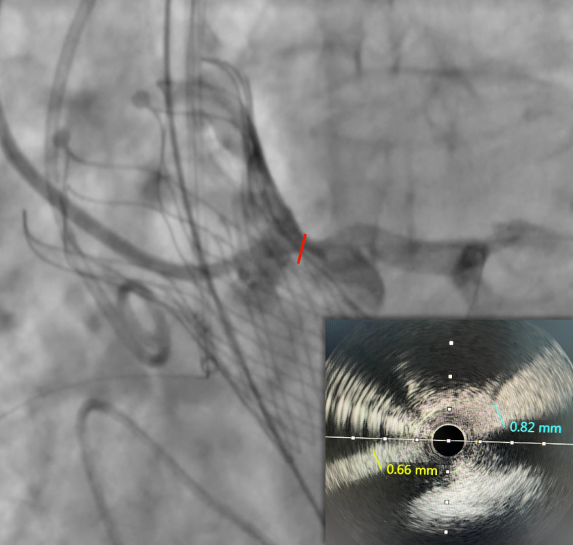 昆医附属延安医院结构性心脏病学组为一位冠脉高风险四叶瓣重度AS患者完TAVR+PCI+PDA一站式治疗 -- 严道医声网